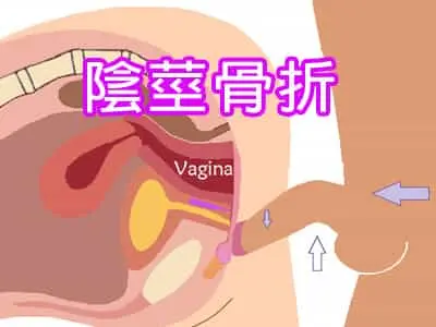 陰莖骨折