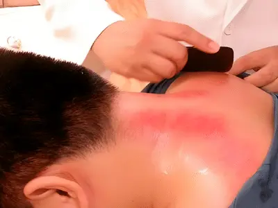 刮痧